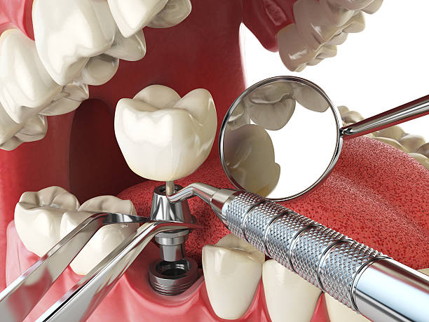 Best Emergency Dentist for Lost Fillings or Crowns in Llington, MI